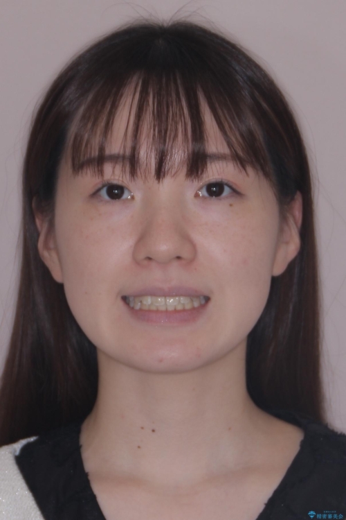 【モニター】前歯のデコボコをスッキリ解消!目立ちにくいワイヤー矯正でスピーディに治療完了の治療後(顔貌)