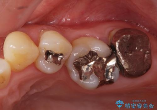 銀歯を白くしたいセラミック治療。の治療前