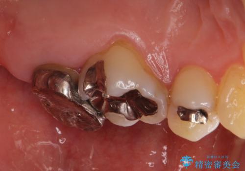 銀歯を白くしたいセラミック治療。の治療前