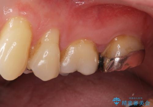 銀歯を白くしたいセラミック治療。の治療前