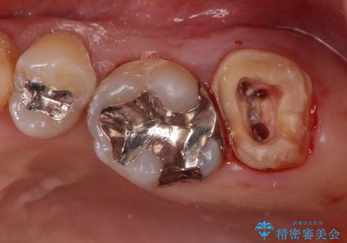 銀歯を白くしたいセラミック治療。の治療中
