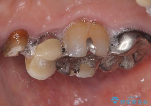 自然な美しさと強度を両立!右上小臼歯の被せもの脱離に対する審美補綴治療の治療前