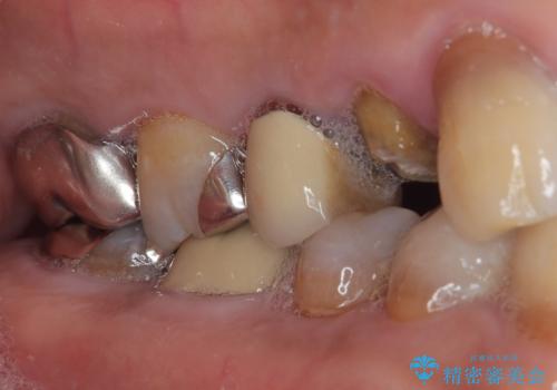 自然な美しさと強度を両立!右上小臼歯の被せもの脱離に対する審美補綴治療の治療前