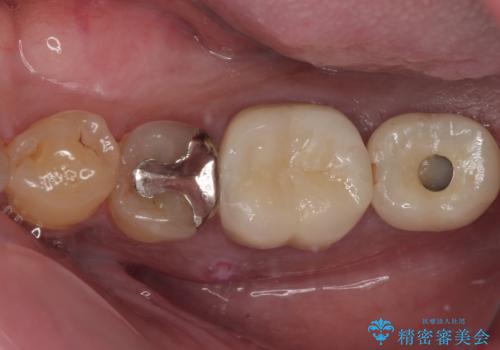 咬合力で破折した奥歯 抜歯即時インプラントで短期間治療の症例 治療前