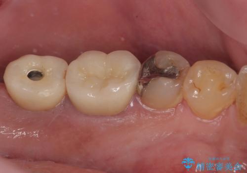 咬合力で破折した奥歯 抜歯即時インプラントで短期間治療の治療前