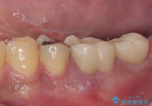 咬合力で破折した奥歯 抜歯即時インプラントで短期間治療の治療前