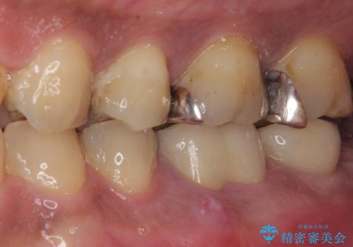 咬合力で破折した奥歯 抜歯即時インプラントで短期間治療の治療前