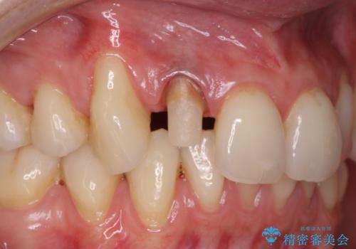 前歯の形と変色が気になる。 ジルコニアクラウンでの修復処置の治療中