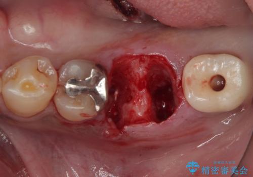 咬合力で破折した奥歯 抜歯即時インプラントで短期間治療の治療前