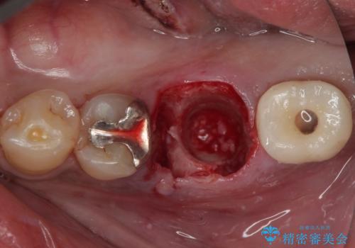 咬合力で破折した奥歯 抜歯即時インプラントで短期間治療の治療中