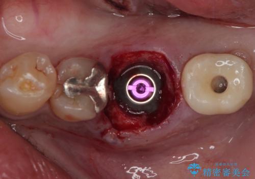 咬合力で破折した奥歯 抜歯即時インプラントで短期間治療の治療後