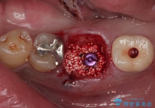 咬合力で破折した奥歯 抜歯即時インプラントで短期間治療の治療前