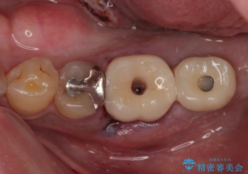 咬合力で破折した奥歯 抜歯即時インプラントで短期間治療の治療中