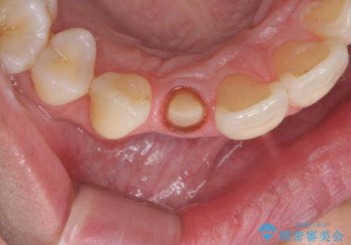 前歯の形と変色が気になる。 ジルコニアクラウンでの修復処置の治療中