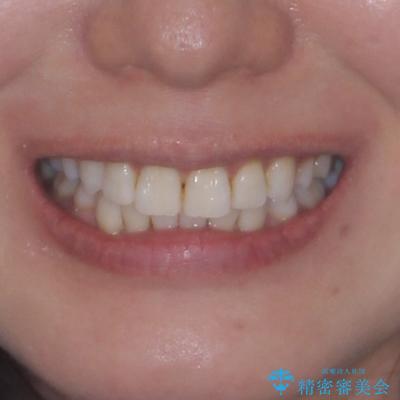 矯正治療の後戻り インビザラインで短期間矯正治療の治療後(顔貌)