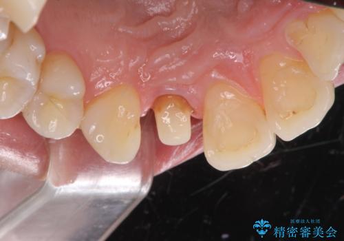 前歯の形と変色が気になる。 ジルコニアクラウンでの修復処置の治療中