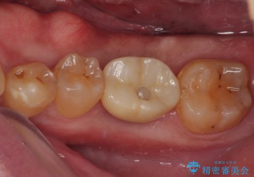 咬合力で破折した奥歯 抜歯即時埋入インプラントによる補綴治療の症例 治療後