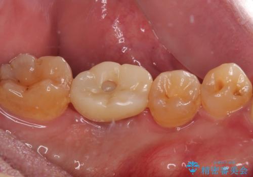 咬合力で破折した奥歯 抜歯即時埋入インプラントによる補綴治療の治療後