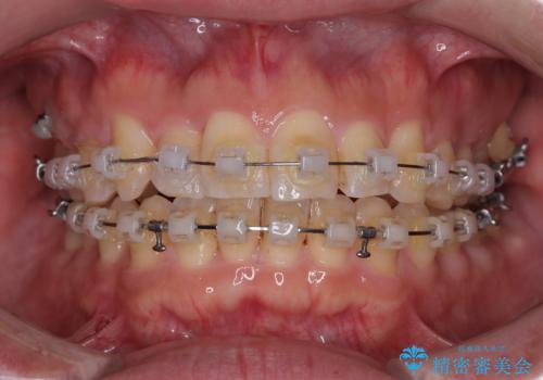 インビザラインは煩わしい ワイヤー矯正で短期間矯正治療の治療中