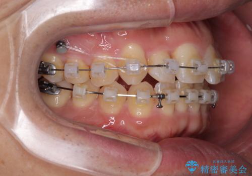 インビザラインは煩わしい ワイヤー矯正で短期間矯正治療の治療中