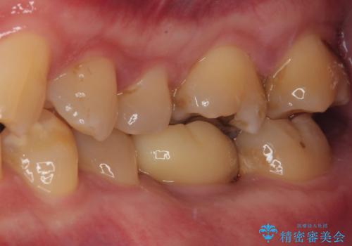 咬合力で破折した奥歯 抜歯即時埋入インプラントによる補綴治療の治療後