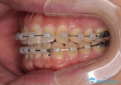 インビザラインは煩わしい ワイヤー矯正で短期間矯正治療の治療中