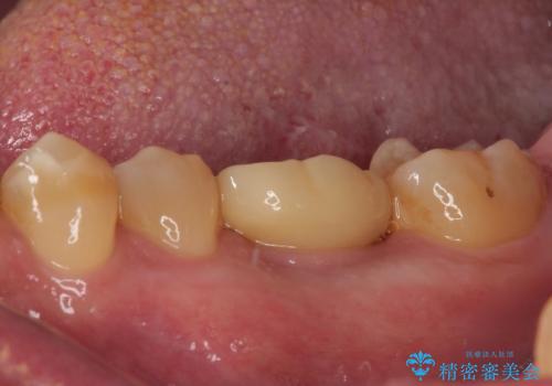 咬合力で破折した奥歯 抜歯即時埋入インプラントによる補綴治療の治療後