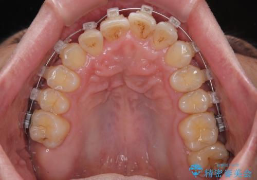 インビザラインは煩わしい ワイヤー矯正で短期間矯正治療の治療中