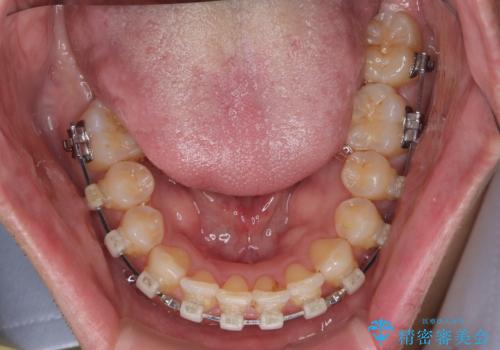 インビザラインは煩わしい ワイヤー矯正で短期間矯正治療の治療中