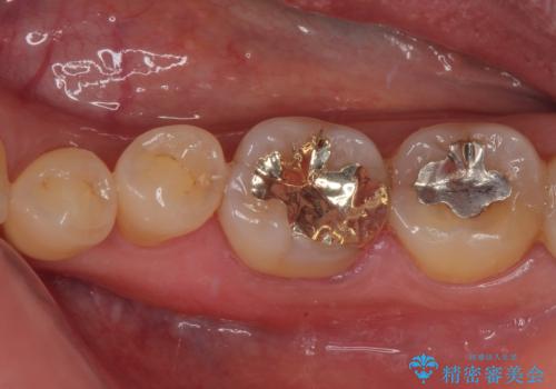 銀歯の周りがむし歯に ゴールドインレーによるむし歯治療の症例 治療後