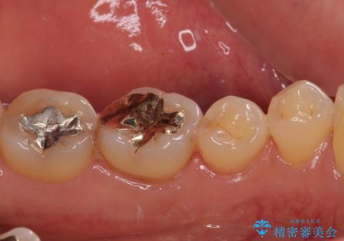 銀歯の周りがむし歯に ゴールドインレーによるむし歯治療の治療後