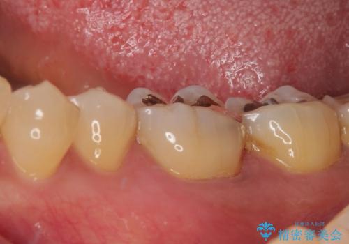 銀歯の周りがむし歯に ゴールドインレーによるむし歯治療の治療後