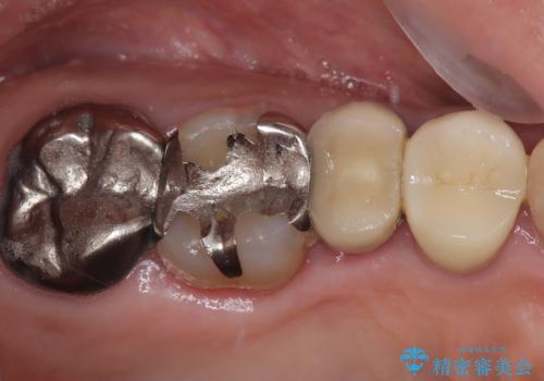 自然な美しさと強度を両立!右上小臼歯の被せもの脱離に対する審美補綴治療の症例 治療後