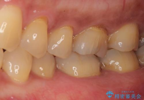 銀歯の周りがむし歯に ゴールドインレーによるむし歯治療の治療後