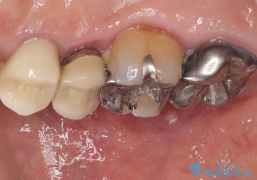 自然な美しさと強度を両立!右上小臼歯の被せもの脱離に対する審美補綴治療の治療後