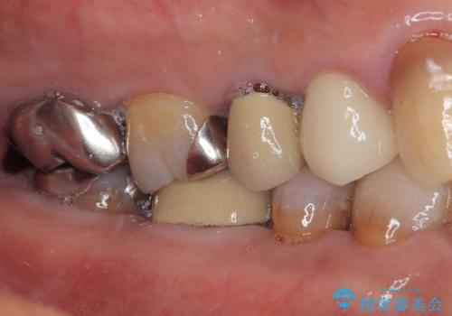 自然な美しさと強度を両立!右上小臼歯の被せもの脱離に対する審美補綴治療の治療後