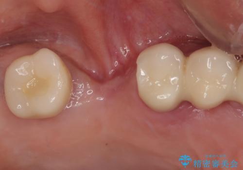 抜けてしまった奥歯 短期間インプラント治療の症例 治療前