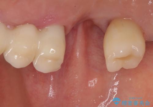 抜けてしまった奥歯 短期間インプラント治療の治療前