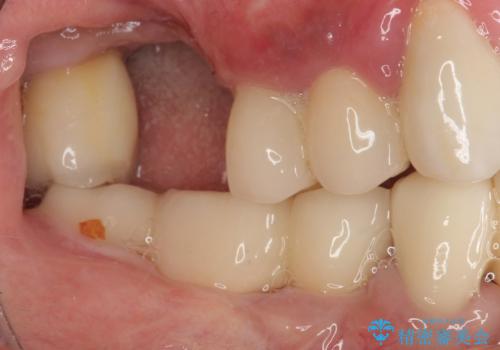 抜けてしまった奥歯 短期間インプラント治療の治療前