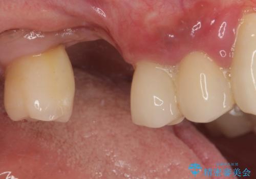 抜けてしまった奥歯 短期間インプラント治療の治療前
