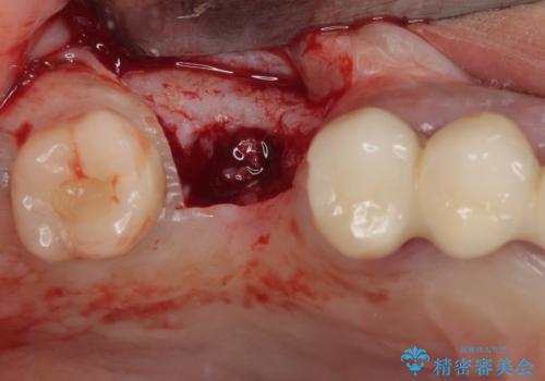 抜けてしまった奥歯 短期間インプラント治療の治療前