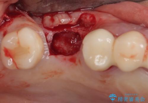 抜けてしまった奥歯 短期間インプラント治療の治療中