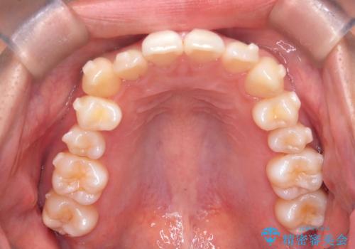 非抜歯矯正で八重歯を改善|短期間8か月で美しい歯並びに|インビザラインライト上顎のみで矯正の治療中