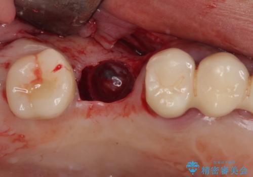 抜けてしまった奥歯 短期間インプラント治療の治療後