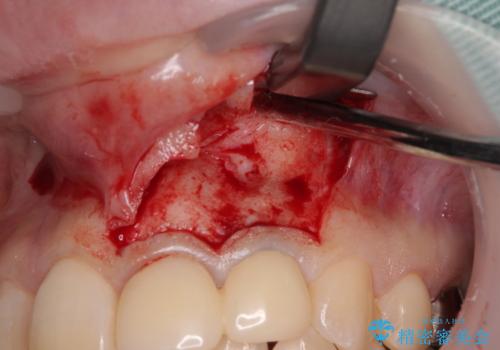 変色してきた歯とプラスチックのクラウン オールセラミッククラウン治療の治療前