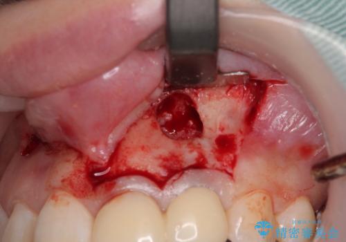 変色してきた歯とプラスチックのクラウン オールセラミッククラウン治療の治療中