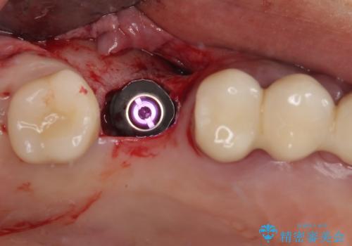 抜けてしまった奥歯 短期間インプラント治療の治療前