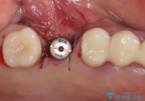 抜けてしまった奥歯 短期間インプラント治療の治療中