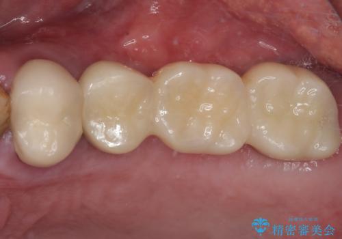 割れてしまった奥歯 抜歯即時埋入インプラントによる短期間治療の治療前