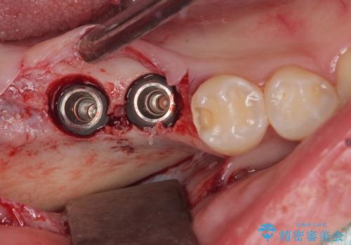 挺出歯を圧下してスペースを確保!目立たない部分矯正で下顎大臼歯にインプラント治療を実現の治療中